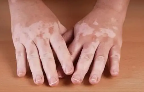 hipopigmentação causada por vitiligo