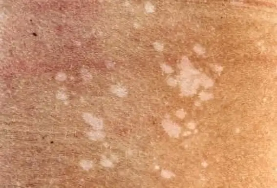 Tinea Versicolor