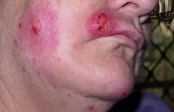 Fotografie infekcie Staph na koži