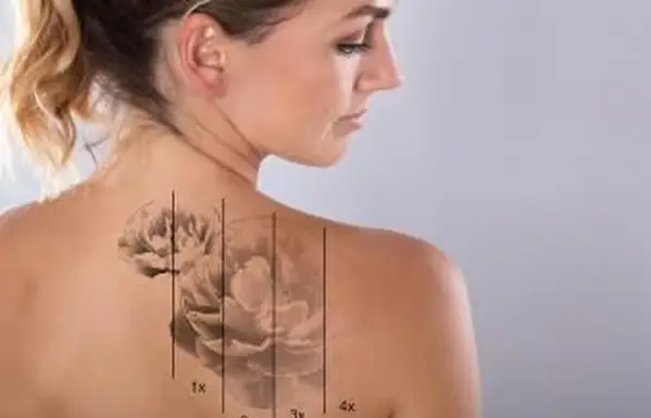 Ako zosvetliť tetovanie prirodzene bez bolesti