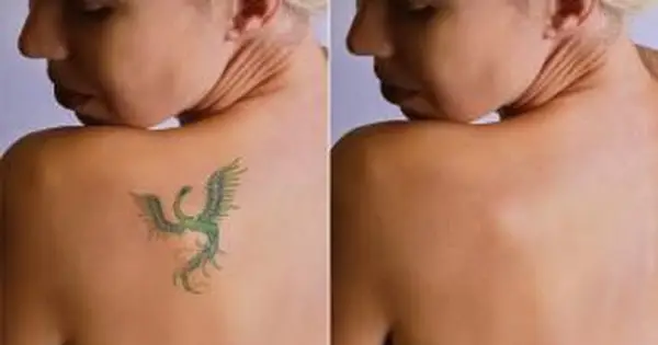 Détatouage au laser avant et après