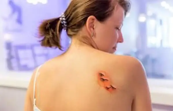 Síntomas de tatuajes infectados