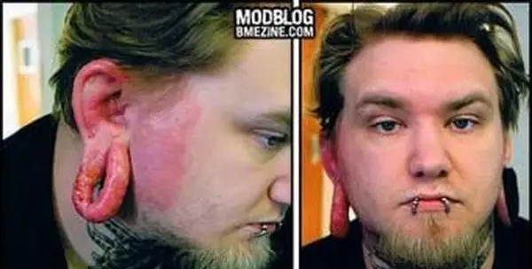 Trzy obrazy chrupiącej, rozciągniętej infekcji ucha