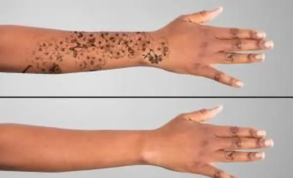 Come rimuovere i tatuaggi Stick e Poke