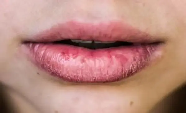 La carenza di vitamine può causare labbra screpolate croniche?